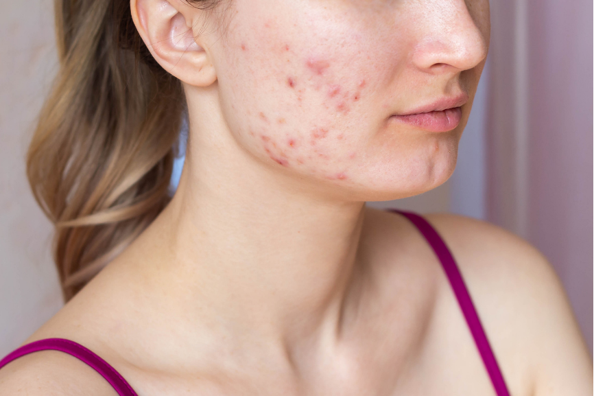 Can Teenagers Prevent Acne?-LUCEBEAUTY